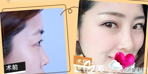 看蘇州康美劉道功做雙眼皮怎么樣