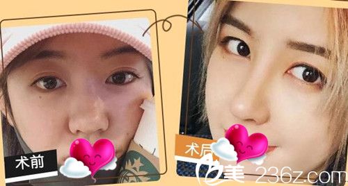 蘇州康美整形陳勇隆鼻效果圖