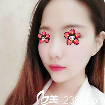 注射玻尿酸填充下巴7天恢復(fù)照 注射玻尿酸填充下巴7天恢復(fù)照