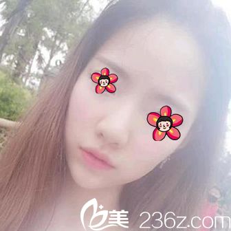 整下巴是選擇假體墊還是玻尿酸填充好呢？看看寧波壹加壹醫(yī)院馬文章玻尿酸隆下巴案例效果吧