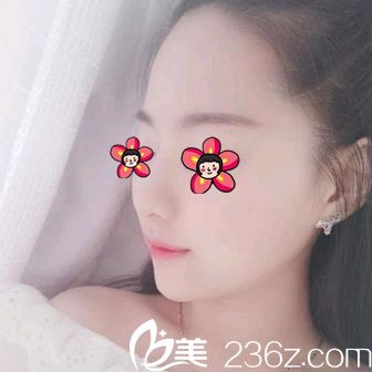 注射玻尿酸填充下巴15天后 注射玻尿酸填充下巴15天后