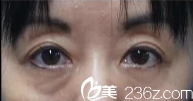 日本花園美容整形醫(yī)院自體脂肪注入填充祛眼袋前 日本花園美容整形醫(yī)院自體脂肪注入填充祛眼袋前