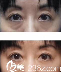 花園美容整形醫(yī)院自體脂肪注入填充祛眼袋前后對比 花園美容整形醫(yī)院自體脂肪注入填充祛眼袋前后對比