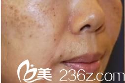 日本花園美容整形醫(yī)院皮秒激光祛斑前 日本花園美容整形醫(yī)院皮秒激光祛斑前