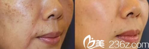 大庭英信醫(yī)生皮秒激光祛斑前后對比 大庭英信醫(yī)生皮秒激光祛斑前后對比