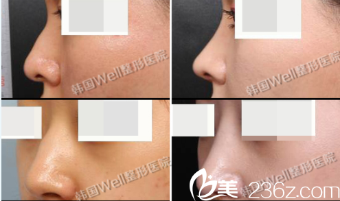 韓國(guó)well整形醫(yī)院鼻部整形真人案例 韓國(guó)well整形醫(yī)院鼻部整形真人案例