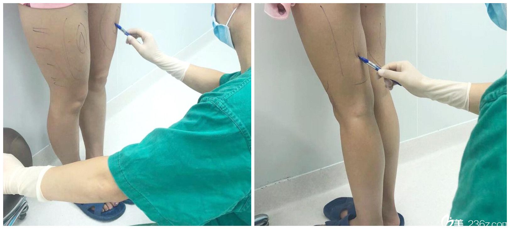 在合肥福華整形做大腿環(huán)吸術(shù)前設(shè)計(jì) 在合肥福華整形做大腿環(huán)吸術(shù)前設(shè)計(jì)