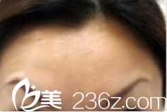 在日本城野醫(yī)生醫(yī)療美容醫(yī)院進行瘦臉除皺祛皺后，我終于找到了自己的白馬王子!