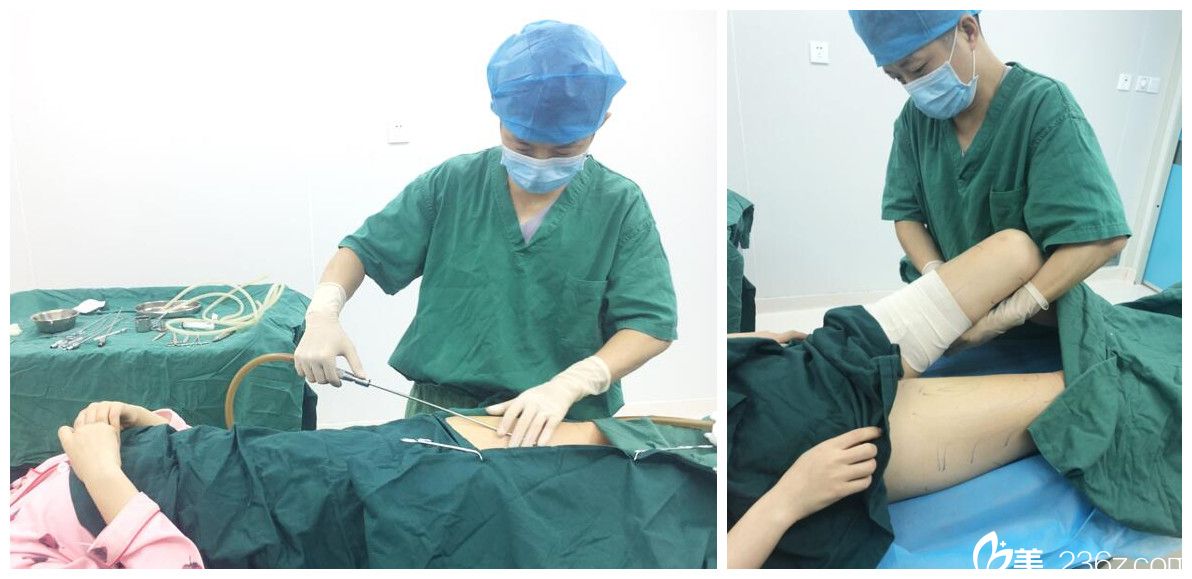 福華整形趙章杰做大腿抽脂手術(shù)過程中 福華整形趙章杰做大腿抽脂手術(shù)過程中