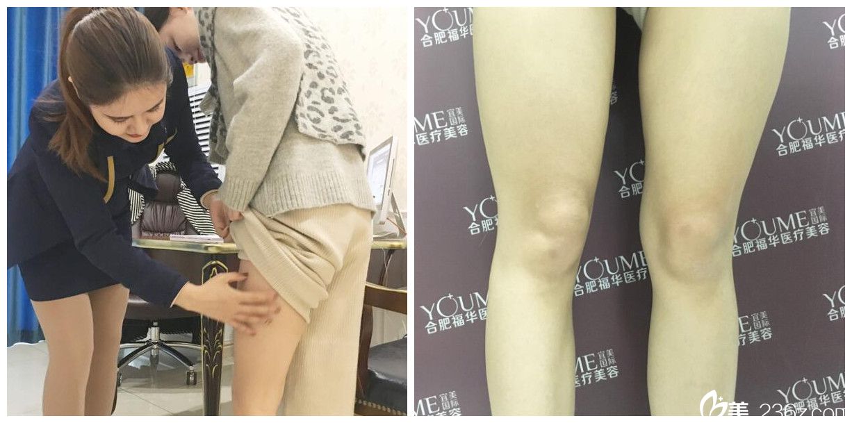 找趙章杰做大腿環(huán)吸術(shù)前面診及拍照 找趙章杰做大腿環(huán)吸術(shù)前面診及拍照