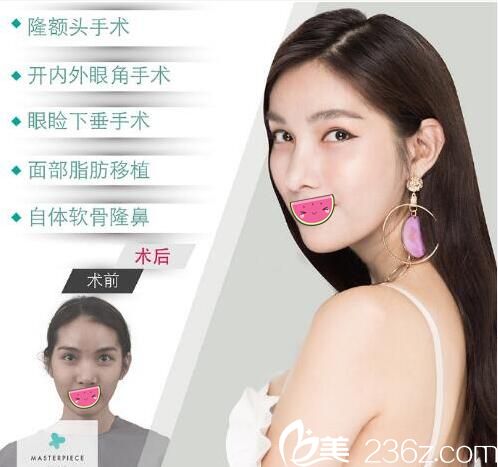 泰國馬斯特皮診所雙眼皮隆鼻脂肪填充案例 泰國馬斯特皮診所雙眼皮隆鼻脂肪填充案例