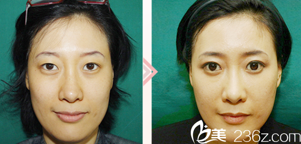 自體脂肪移植真人案例 自體脂肪移植真人案例