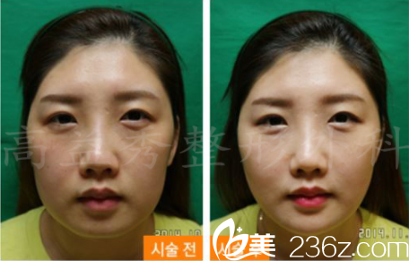 韓國高益秀整形外科VOV提升術真人案例 韓國高益秀整形外科VOV提升術真人案例