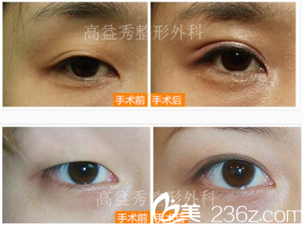 韓國高益秀雙眼皮整形前后對比 韓國高益秀雙眼皮整形前后對比