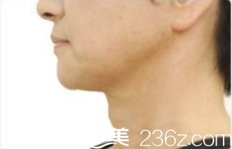 熱瑪吉和線雕哪個效果好?糾結兩個月后去日本城野醫(yī)生醫(yī)療美容醫(yī)院做了熱瑪吉緊膚