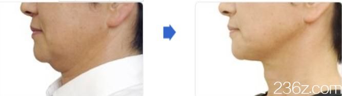 日本城野醫(yī)生醫(yī)療美容醫(yī)院熱瑪吉緊膚前后對比變化 日本城野醫(yī)生醫(yī)療美容醫(yī)院熱瑪吉緊膚前后對比變化