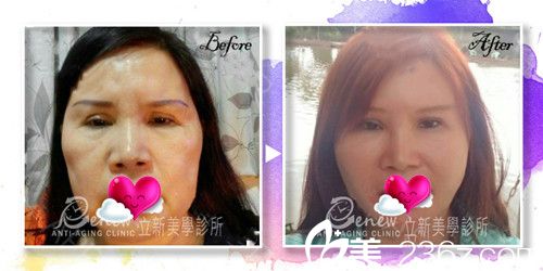 立新美學(xué)診所線雕提升案例 立新美學(xué)診所線雕提升案例