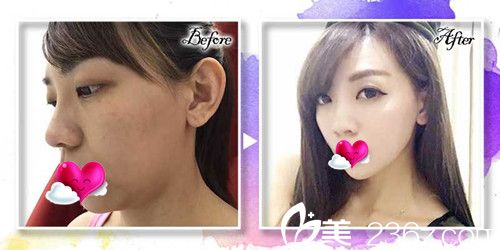 中國臺灣立新美學(xué)診所Quill8字線雕拉提案例 中國臺灣立新美學(xué)診所Quill8字線雕拉提案例