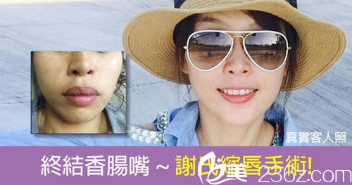 中國(guó)臺(tái)灣立新美學(xué)診所謝東穎縮唇手術(shù)案例 中國(guó)臺(tái)灣立新美學(xué)診所謝東穎縮唇手術(shù)案例