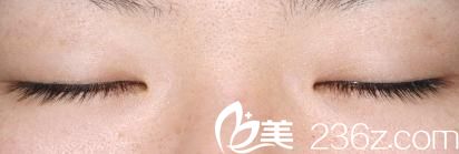 酒井倫明埋線法雙眼皮前閉眼時候 酒井倫明埋線法雙眼皮前閉眼時候