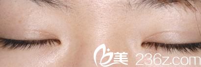 酒井倫明埋線法雙眼皮術(shù)后一個月閉眼 酒井倫明埋線法雙眼皮術(shù)后一個月閉眼