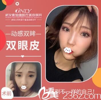 武漢壹加壹李艷冬玫度眉眼雙眼皮案例對比圖