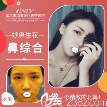 武漢壹加壹付俊利韓式生科鼻綜合隆鼻案例效果對比圖