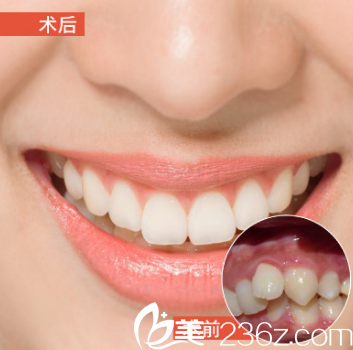 武漢壹加壹周寧金屬托槽矯正案例