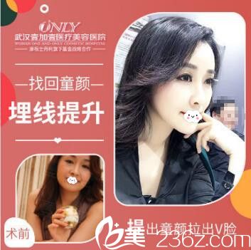 武漢壹加壹王政祥面部線雕埋線提升案例效果圖