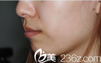 日本酒井形成外科醫(yī)院假體植入墊下巴前 日本酒井形成外科醫(yī)院假體植入墊下巴前