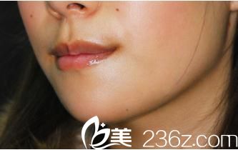 日本哪個(gè)醫(yī)生擅長下巴整形?看我在日本酒井形成外科醫(yī)院苅部大輔醫(yī)生那里做的假體植入墊下巴