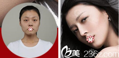 重慶華美隆鼻案例