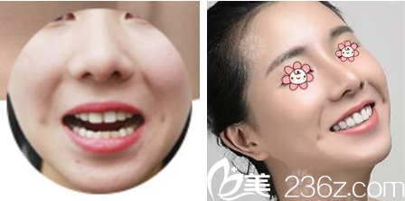 重慶華美牙貼面案例