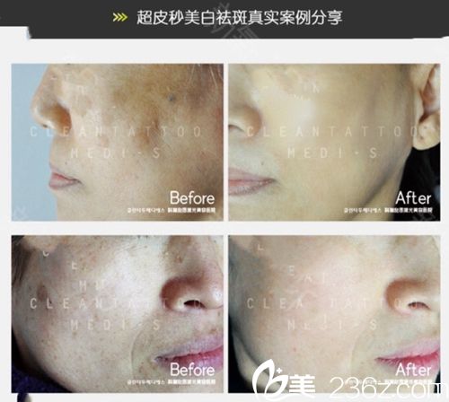 韓國(guó)科琳撻圖皮膚科雙皮秒美白祛斑 韓國(guó)科琳撻圖皮膚科雙皮秒美白祛斑