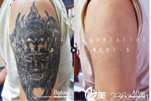 韓國(guó)科琳撻圖皮膚科去紋身 韓國(guó)科琳撻圖皮膚科去紋身