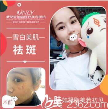 武漢壹加壹醫(yī)療美容醫(yī)院楊麗萍激光祛斑案例效果對比圖 武漢壹加壹醫(yī)療美容醫(yī)院楊麗萍激光祛斑案例效果對比圖