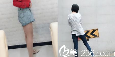 華廷醫(yī)美燃脂塑身術(shù)后對比效果