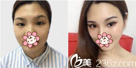 華廷醫(yī)美激光嫩膚祛斑效果圖