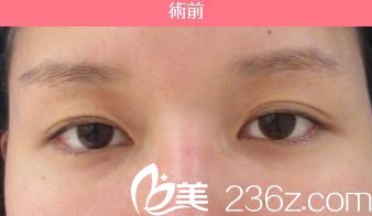 日本東京ISEA整形美容醫(yī)院全切雙眼皮開眼角術(shù)前 日本東京ISEA整形美容醫(yī)院全切雙眼皮開眼角術(shù)前