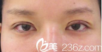 日本東京ISEA整形美容醫(yī)院全切雙眼皮開眼角手術(shù)當(dāng)天 日本東京ISEA整形美容醫(yī)院全切雙眼皮開眼角手術(shù)當(dāng)天