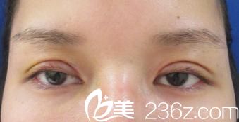 吉種克之全切雙眼皮開眼角手術(shù)一周后 吉種克之全切雙眼皮開眼角手術(shù)一周后