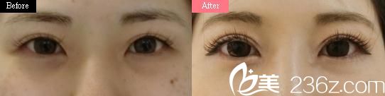 吉種克雙眼皮手術(shù)前后對比 吉種克雙眼皮手術(shù)前后對比