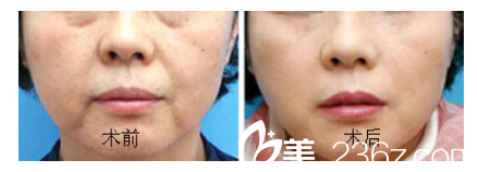 韓國VS醫(yī)院3D網(wǎng)格線提升手術(shù)對比圖 韓國VS醫(yī)院3D網(wǎng)格線提升手術(shù)對比圖