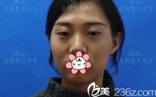 眼部修復(fù)手術(shù)之前的樣子 眼部修復(fù)手術(shù)之前的樣子