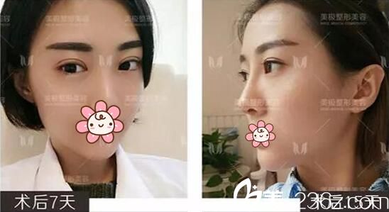 劉潔線雕雙眼皮拆線后效果 劉潔線雕雙眼皮拆線后效果