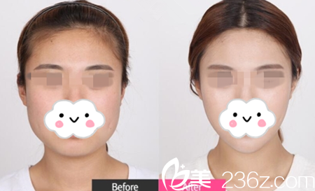 面部輪廓效果對比 面部輪廓效果對比