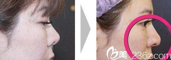 池田欣生鼻尖形成術(shù)前后對比 池田欣生鼻尖形成術(shù)前后對比