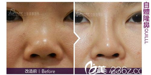 中國臺(tái)灣立新美學(xué)診所自體隆鼻手術(shù)對(duì)比圖 中國臺(tái)灣立新美學(xué)診所自體隆鼻手術(shù)對(duì)比圖