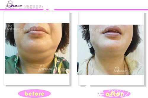 顏仲毅醫(yī)師做的超神波溶脂去除雙下巴案例 顏仲毅醫(yī)師做的超神波溶脂去除雙下巴案例