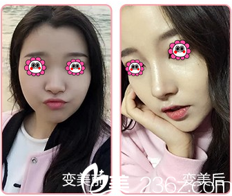 北京百達(dá)麗半肋軟骨鼻綜合隆鼻特惠進(jìn)行中！價(jià)格30000元起